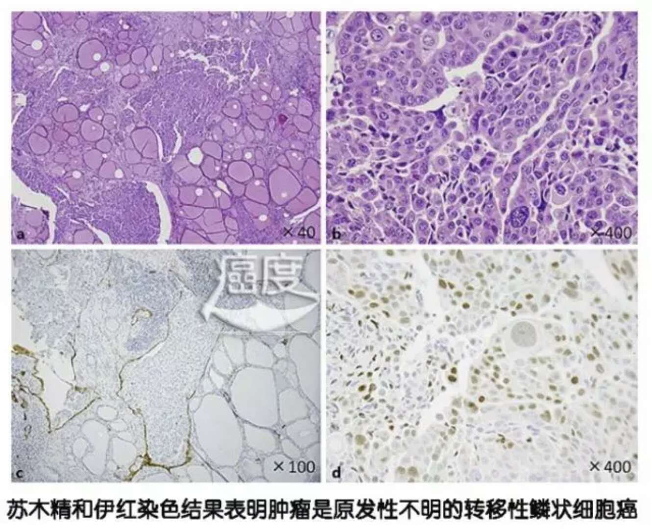 贝伐珠单抗的副作用_胸腔积液贝伐珠单抗_贝伐珠单抗价格