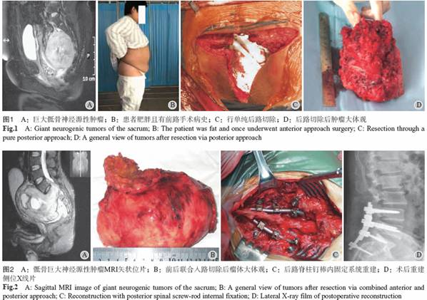 贝伐单抗和贝伐珠单抗_贝伐珠单抗注射液_贝伐单抗化疗后饮食