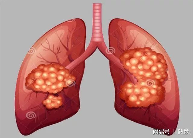 贝伐珠单抗可以报销吗_贝伐珠单抗_肺鳞癌手术后能用贝伐珠单抗