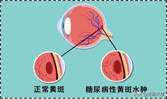 贝伐珠单抗治疗肺腺癌_贝伐单抗-阿瓦斯汀大陆卖多少钱?_贝伐单抗治疗HHT效果显著