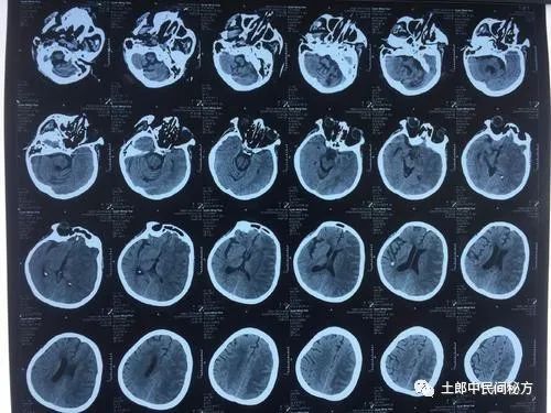 结肠癌晚期 贝伐珠单抗_贝伐珠单抗可以报销吗_贝伐珠单抗对肺腺癌的应用