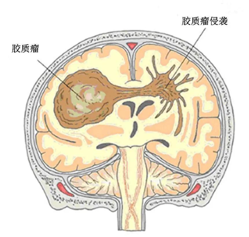 INC国际神经外科医生集团·神经外科系统肿瘤儿童常见的实体瘤