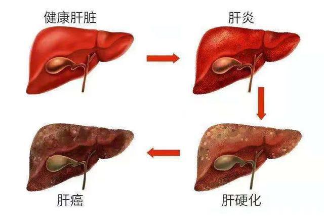 肝癌吃了索拉非尼肝区疼_cfda 索拉非尼 肝癌_索拉非尼 肝癌 缺点