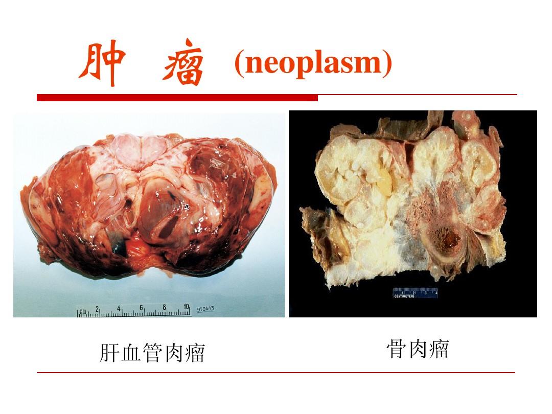 肝癌吃了索拉非尼肝区疼_肝癌索拉非尼效果_索拉非尼肝癌辅助治疗