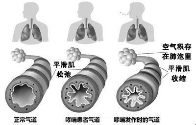 贝伐珠单抗治疗的患者发生严重的胃肠道穿孔及严重瘘管