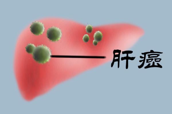 ,索拉非尼治疗晚期肝癌的分子靶向机制及靶向治疗现状