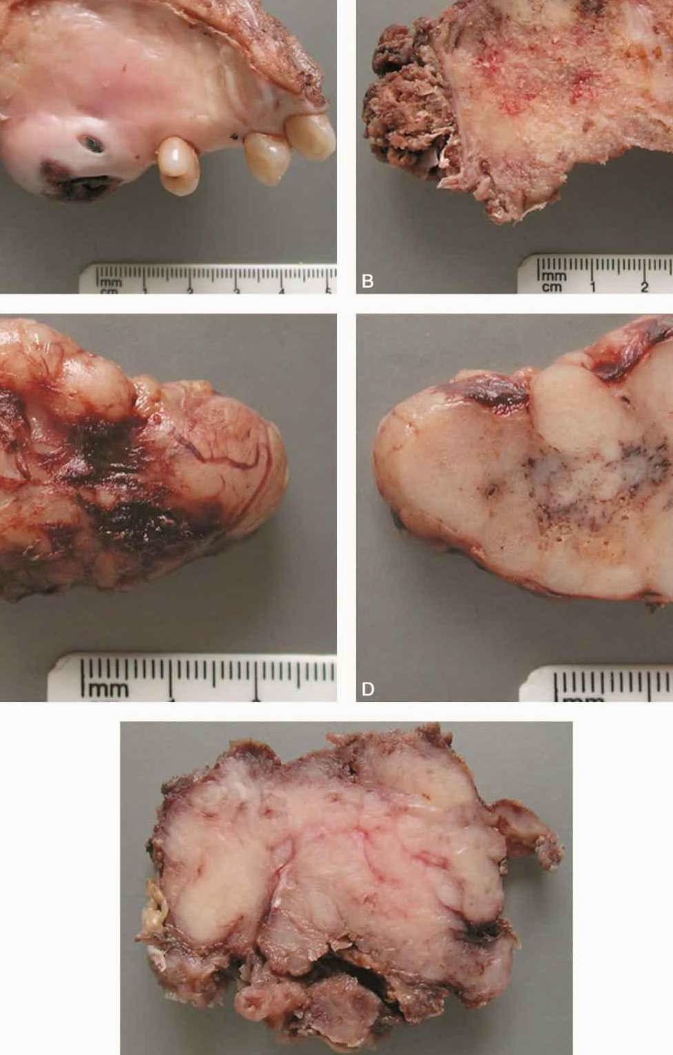 腺样囊性癌用贝伐珠单抗_贝伐珠单抗是化疗吗_贝伐珠单抗价格