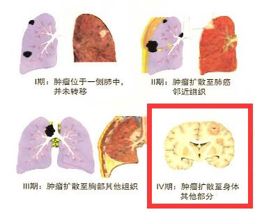 肺癌靶向药物美罗凯_肺癌晚期最好的靶向药_肺癌靶向药吉非替尼片