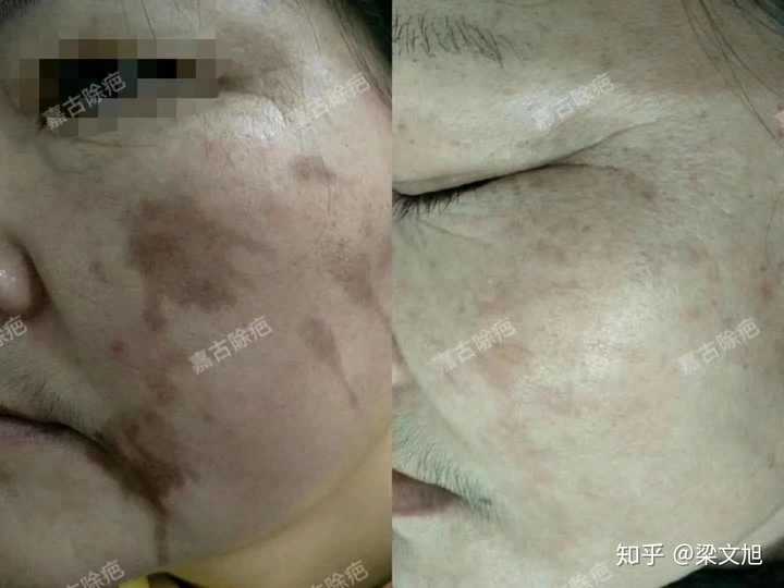 色素沉着点_色素提取留下色沉怎么去除_吉非替尼色素沉着