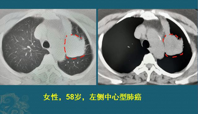 易瑞沙耐药后怎么办_易瑞沙治愈肺癌耐药_易瑞沙耐药奥希替尼声音嘶哑