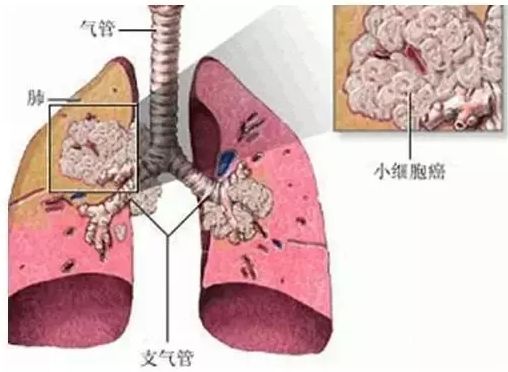 吉非替尼片尼片肺癌靶向药物的靶向治疗方法