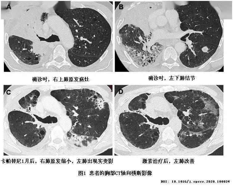 国产苹果酸舒尼替尼胶囊_服用索拉非尼 憨豆精神_国产吉非替尼服用的患者多吗