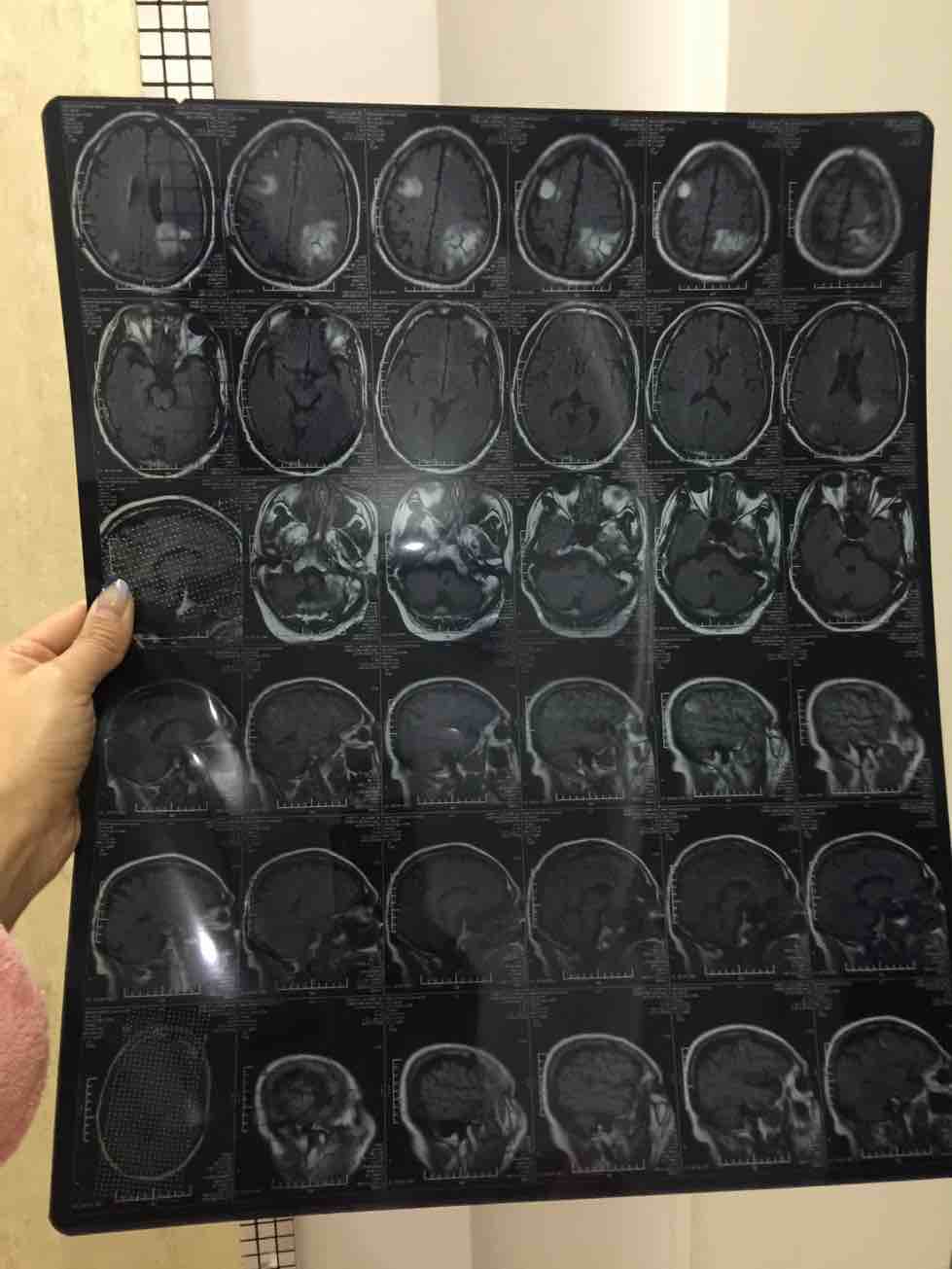 肾透明细胞癌2级_肾透明细胞癌早期_奥希替尼能治肾细胞癌转肺吗