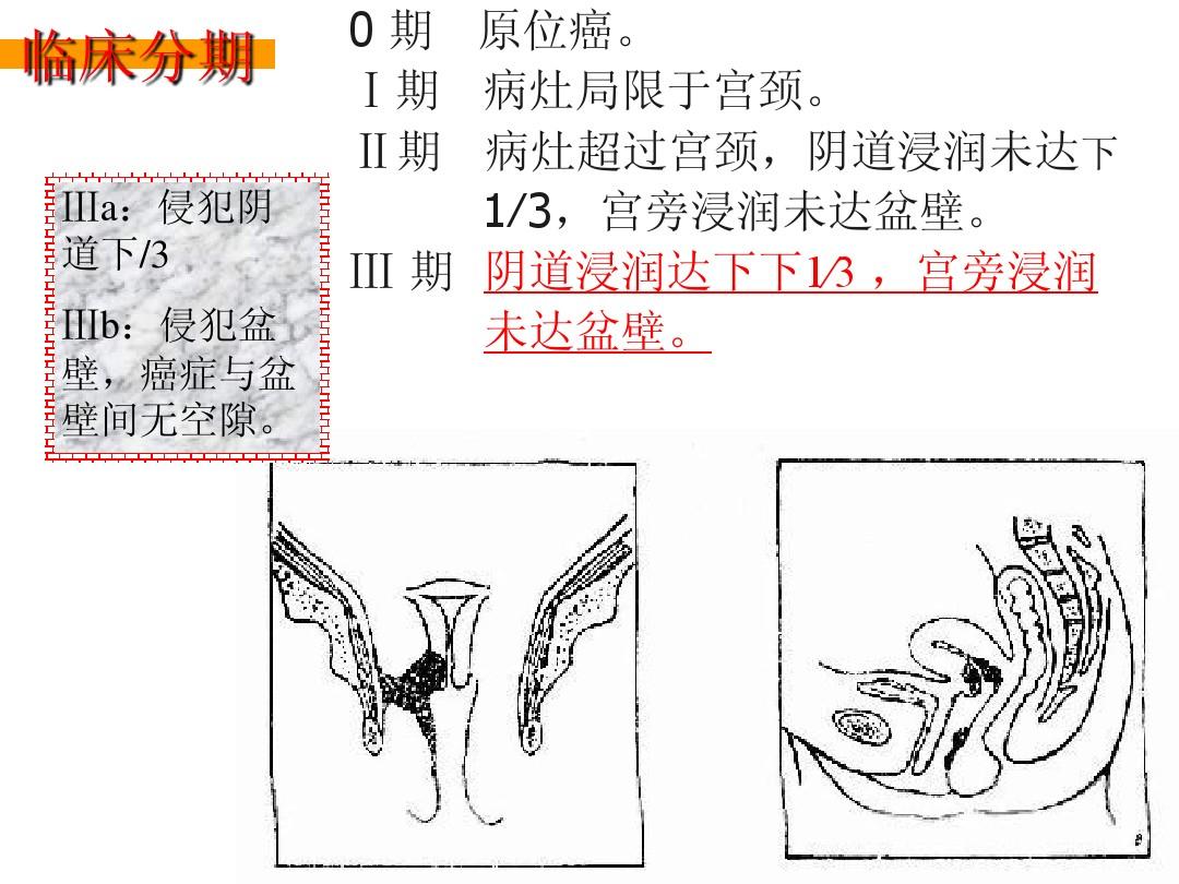 贝伐单抗联合化疗或再添宫颈癌新适应症编译