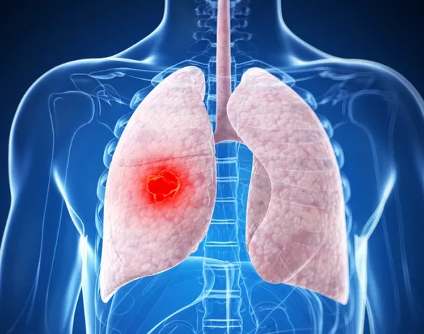 肺腺癌中期患者能否被治愈？纠结不可预知未来