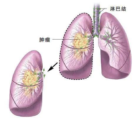 晚期肺腺癌患者的临床效果和Ⅳ期资料与方法