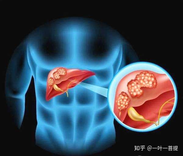 cfda 索拉非尼 肝癌_索拉非尼 抗癌 印度_印度索拉非尼肝癌