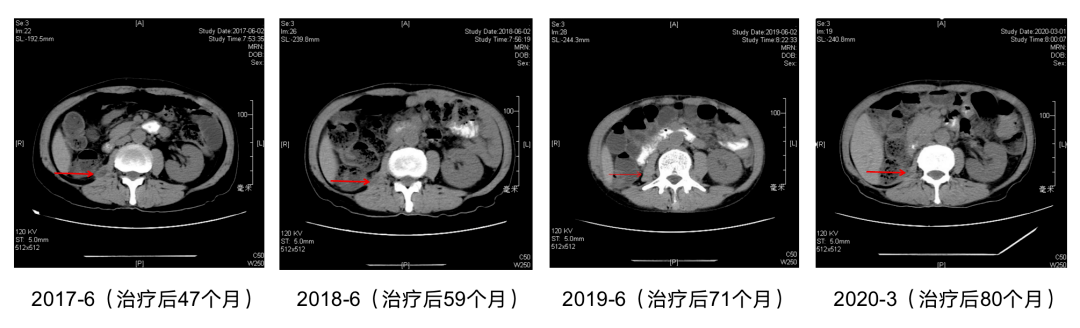 巴瑞克替尼的治疗效果如何呢？达的疗效如何？