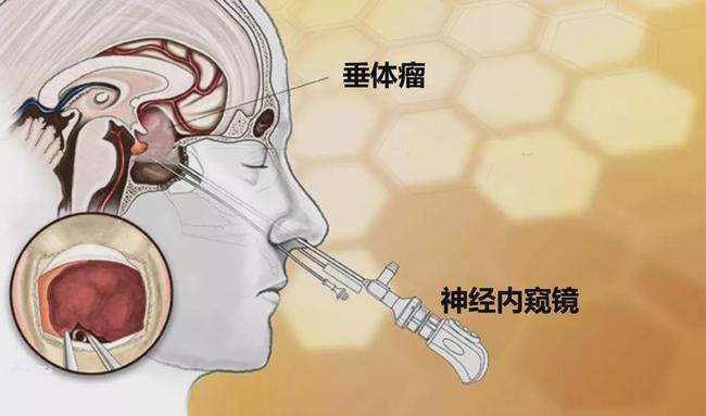 吉非替尼药物反应_药物戒断反应持续多久_药物代谢反应的类型有