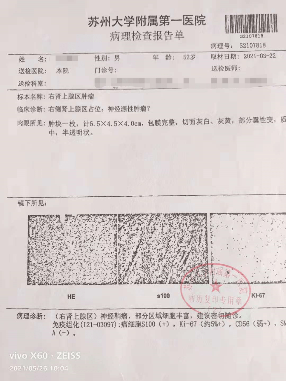 贝伐珠单抗胃出血处理_贝伐珠单抗出血处理_贝伐珠单抗说明书
