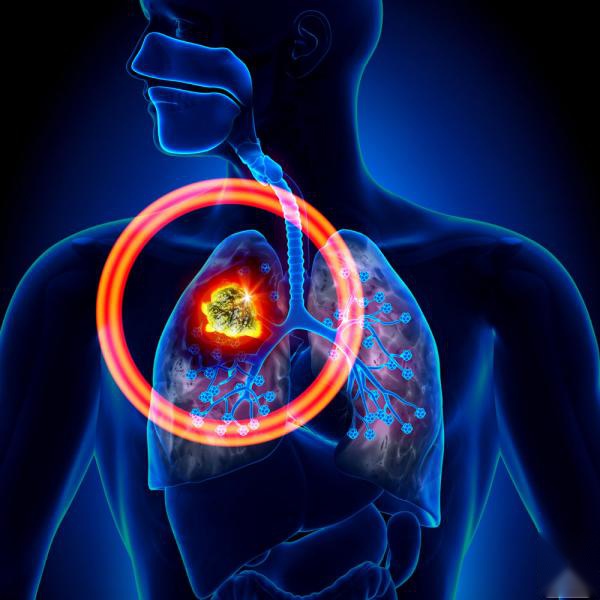
57例女性非小细胞肺癌患者服用吉非替尼的治疗效果