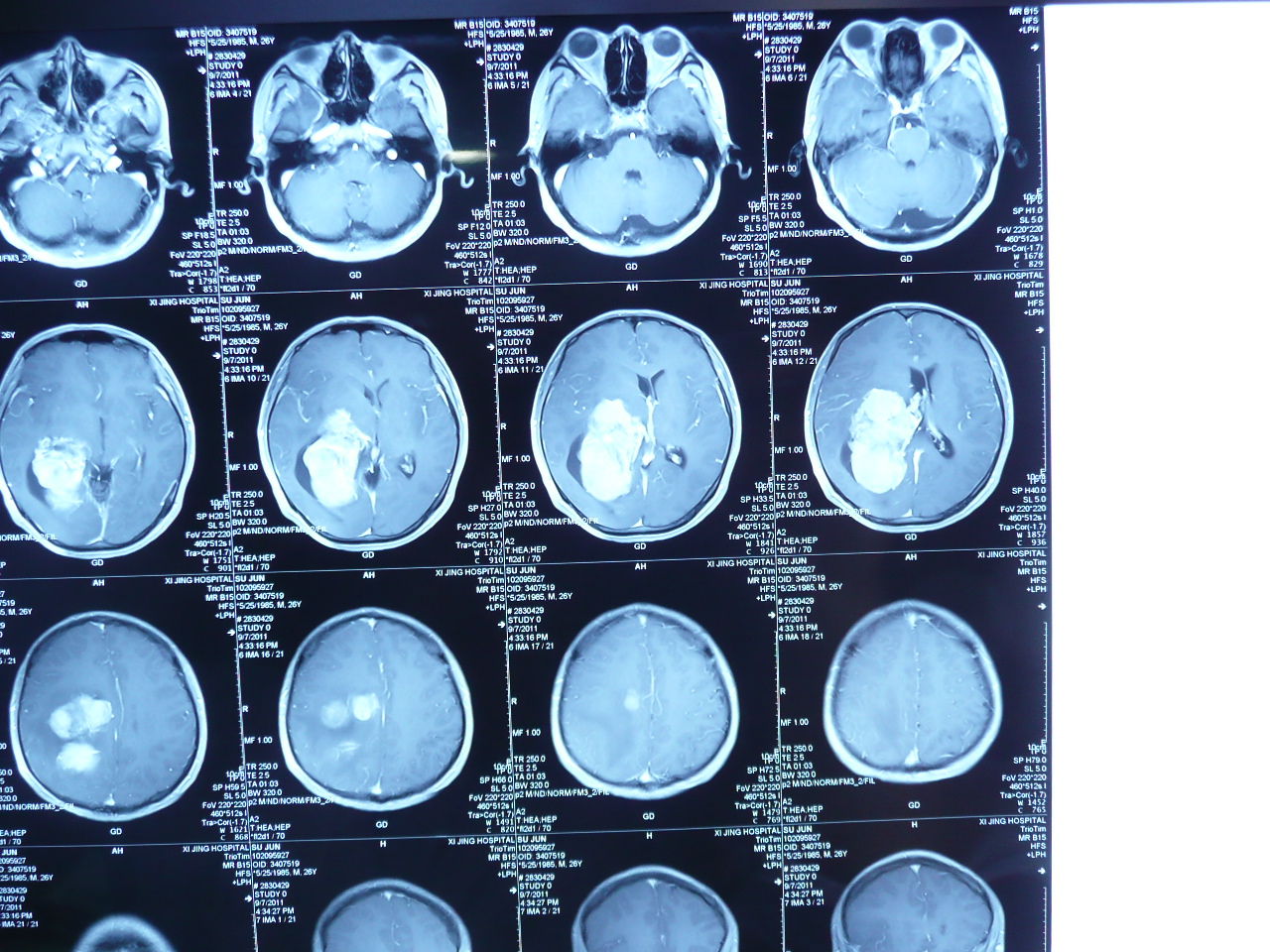 
分子靶向药物索拉非尼临床探索研究均说明了什么？(组图)