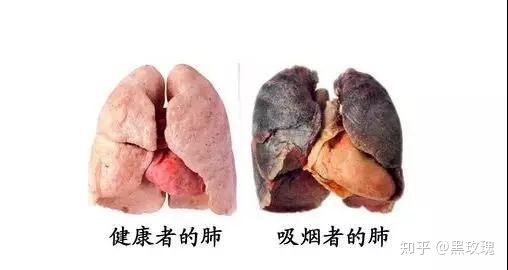 肺癌分型及恶性程度_肺癌晚期脑转移骨转移 服务埃克替尼 能活多久_吉非替尼治疗哪种程度的肺癌