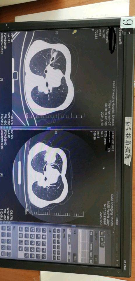 贝伐珠单抗会饿死肿瘤吗_贝伐珠单抗是靶向药吗_贝伐单抗和贝伐珠单抗