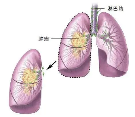 瑞戈非尼联合最佳支持治疗组患者中位总生存期为10.6个月