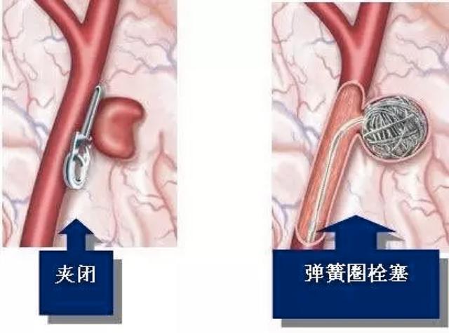 贝伐珠单抗是靶向药吗_贝伐珠单抗能引起头痛吗_贝伐珠单抗不良反应
