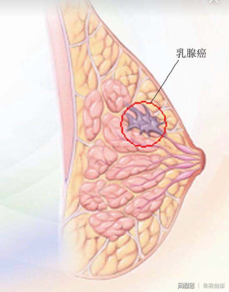 贝伐珠单抗说明书_贝伐珠单抗靶向是啥_贝伐珠单抗在乳腺癌中的应用