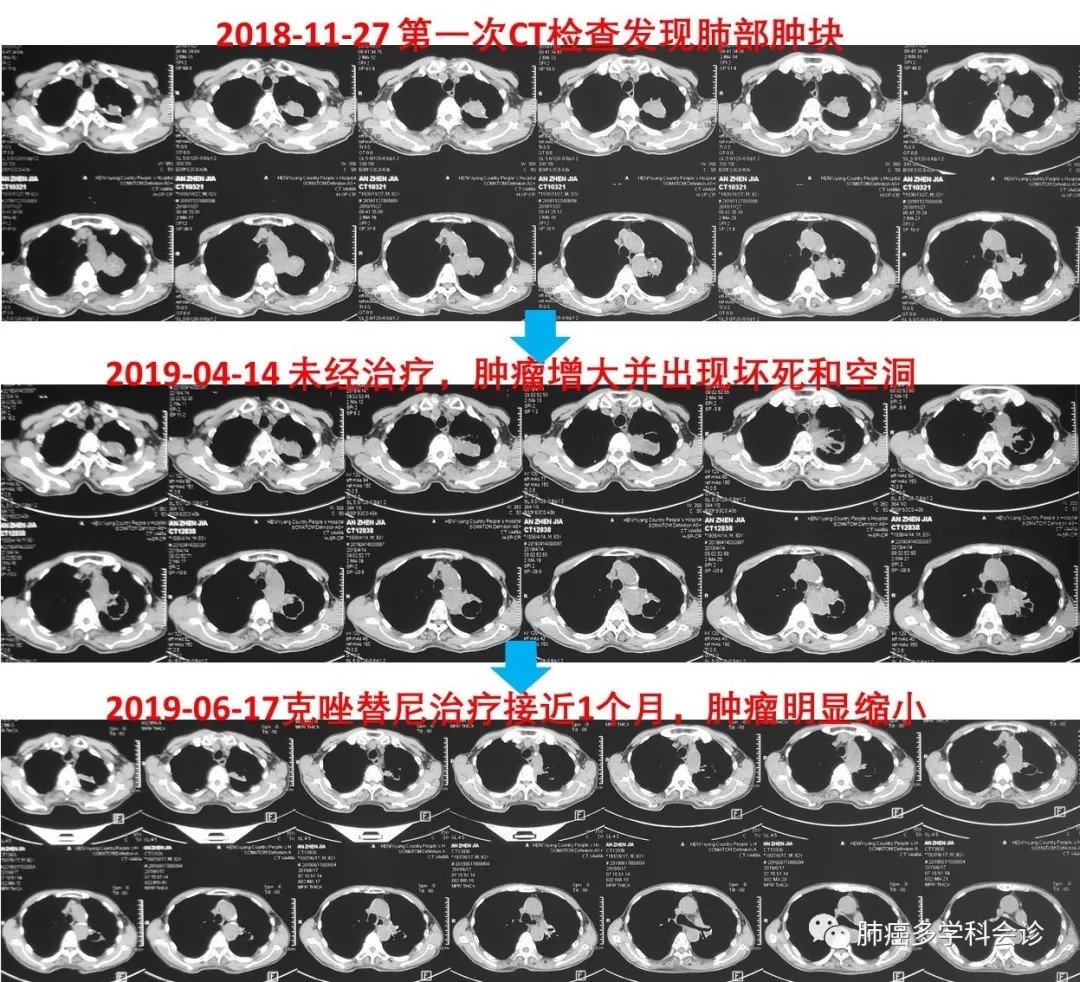 肺癌脑转移吃克唑替尼_azd 9291 奥希替尼_肺癌手术后吃奥希替尼