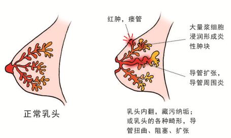 贝伐珠单抗赠药_贝伐珠单抗对乳腺癌_贝伐珠单抗不良反应