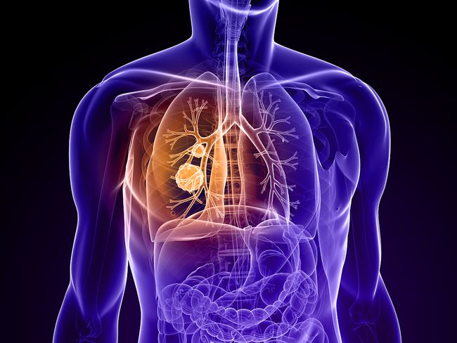 肺癌脑膜转移奥希替尼疗效_肺癌脑膜转移症状_肺癌术后转移脑膜如何治疗