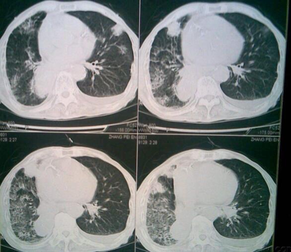 
吉非替尼服用10个月—12个月产生耐药性细胞肺癌
