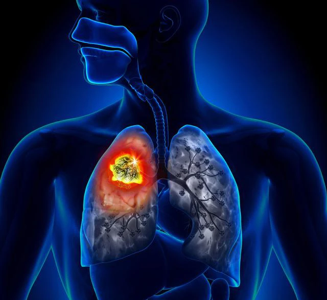 肺鳞癌诊疗：肺癌靶向治疗的新发病例的30左右