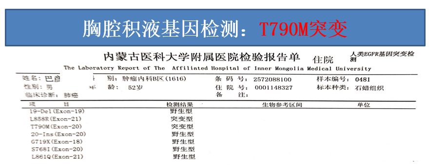 奥希替尼治疗未接受放射治疗系统转移的EGFR突变阳性非小细胞肺癌