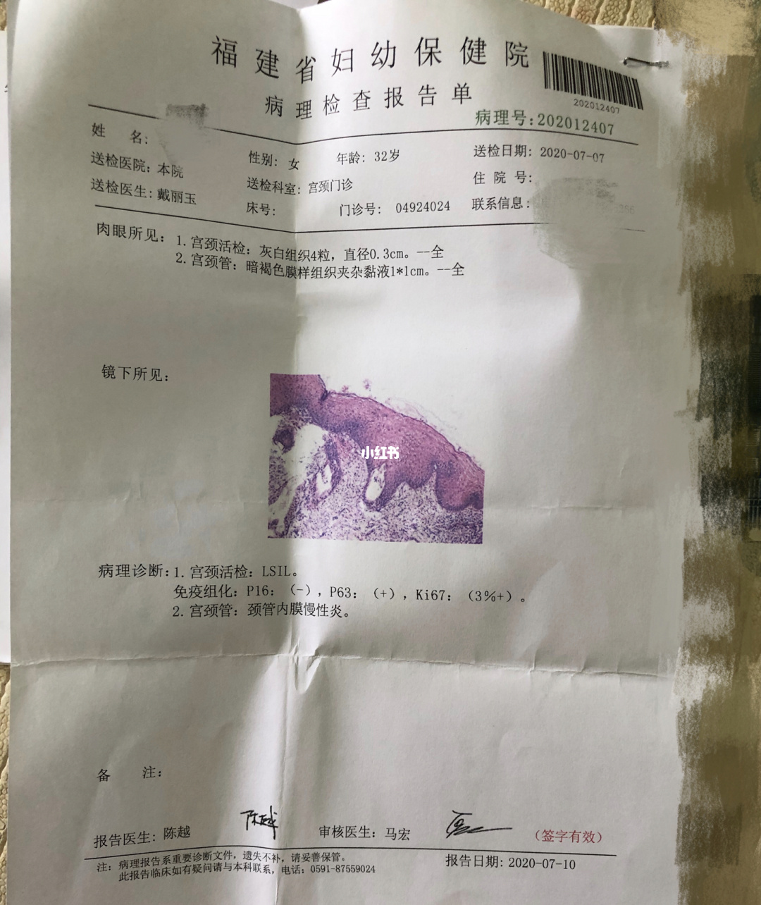 贝伐珠单抗治疗复发性宫颈癌_贝伐珠单抗价格_贝伐单抗对脑转移癌有效