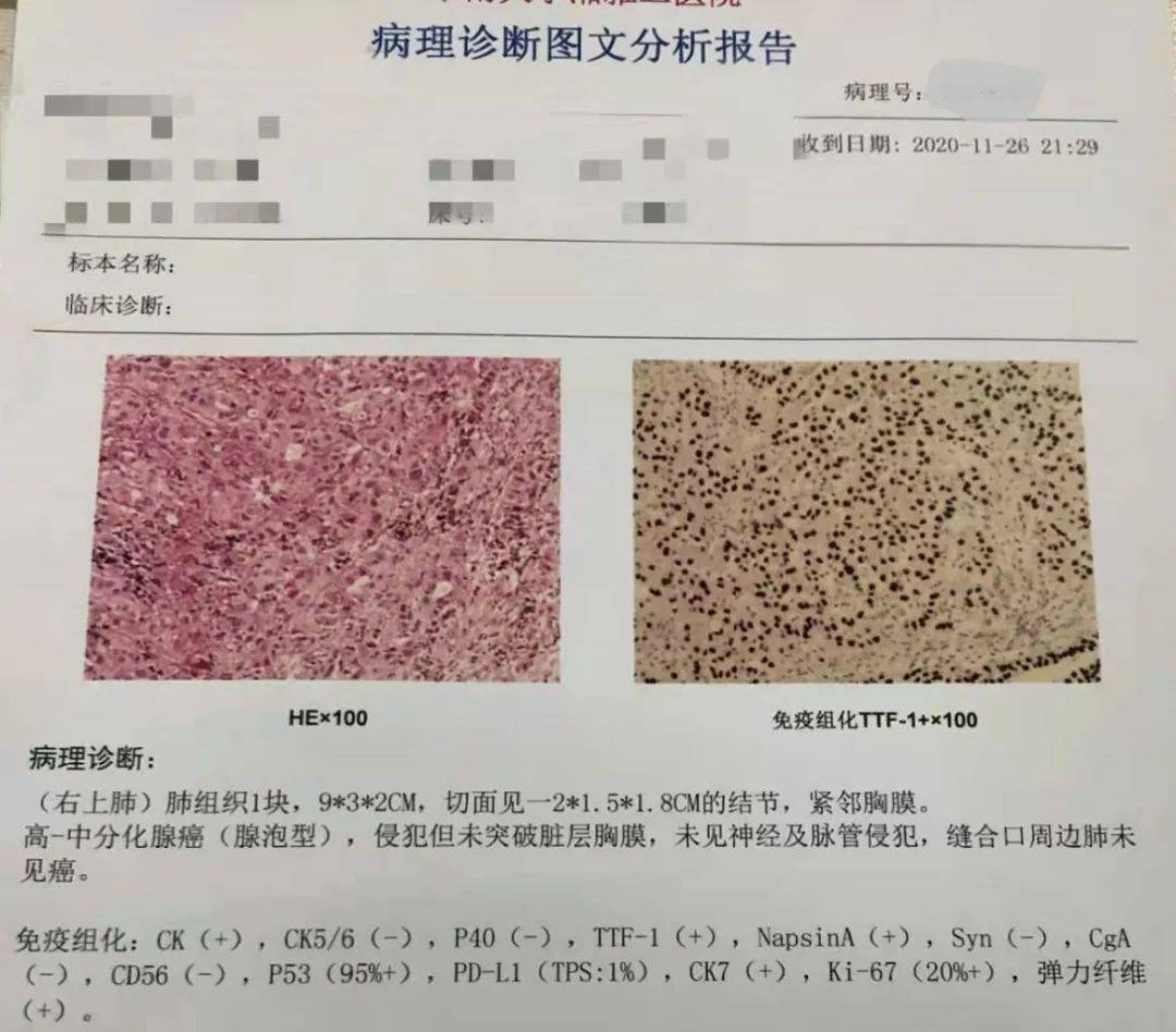 治疗晚期肺腺癌缓慢进展后继续原药应用的临床研究