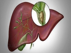 肝癌治疗药物索拉非尼_索拉非尼能治愈肝癌吗_肝癌的索拉非尼
