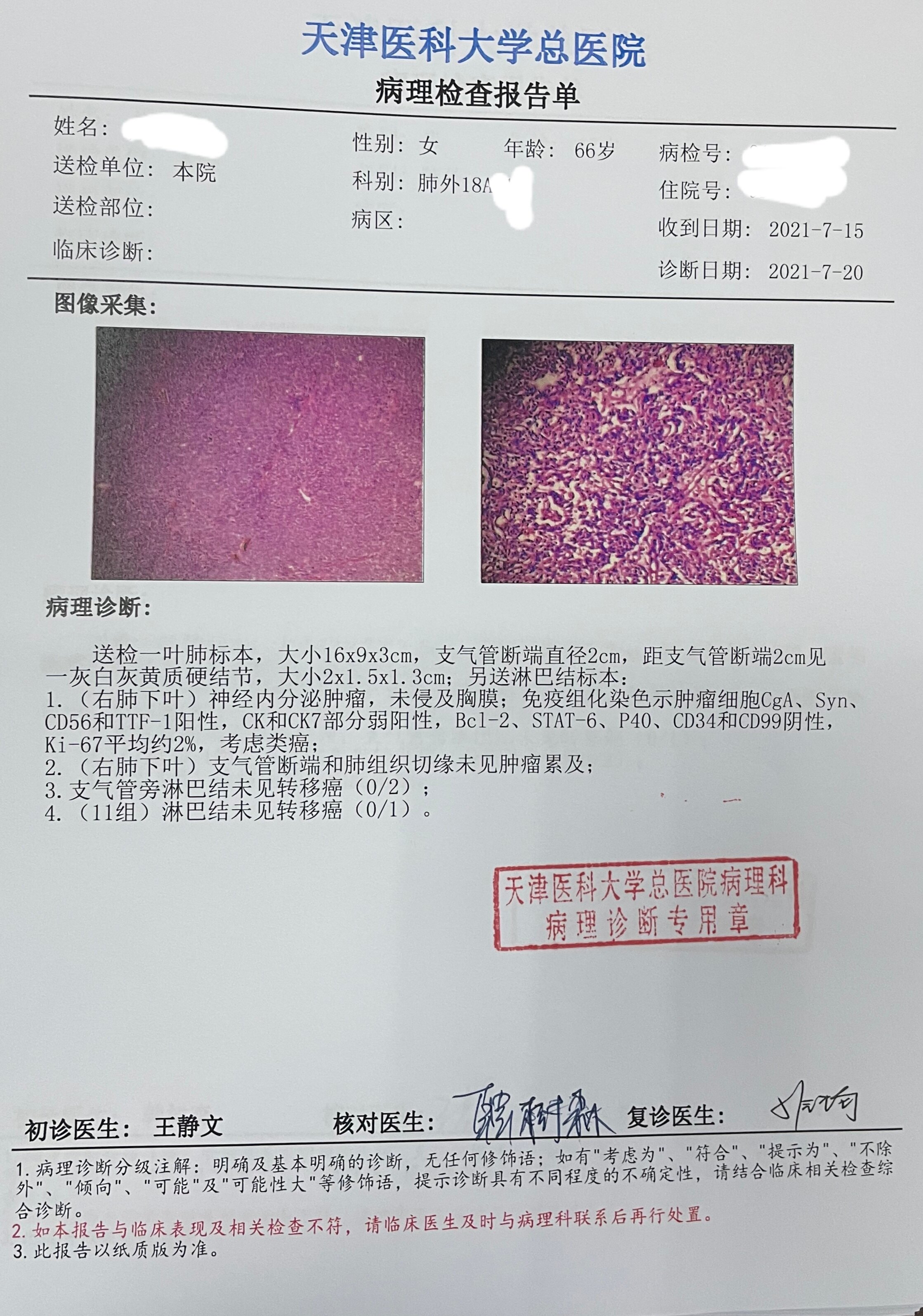 肺腺癌和肺鳞癌的区别_肺鳞癌和肺腺癌的区别_肺鳞癌吃吉非替尼效果