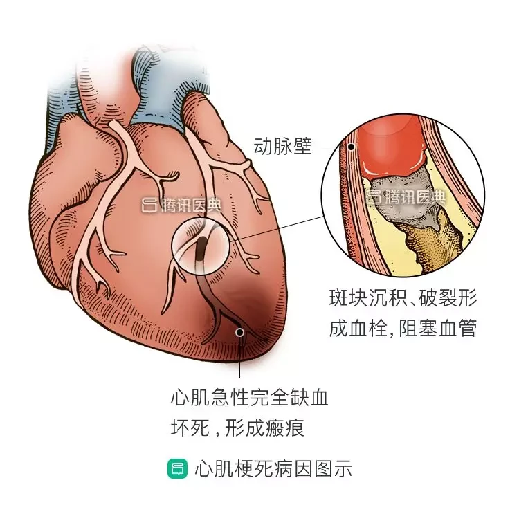 吃索拉非尼能引起牙齿出血吗_焦虑症能引起牙齿不适吗_索拉非尼能治愈肝癌吗