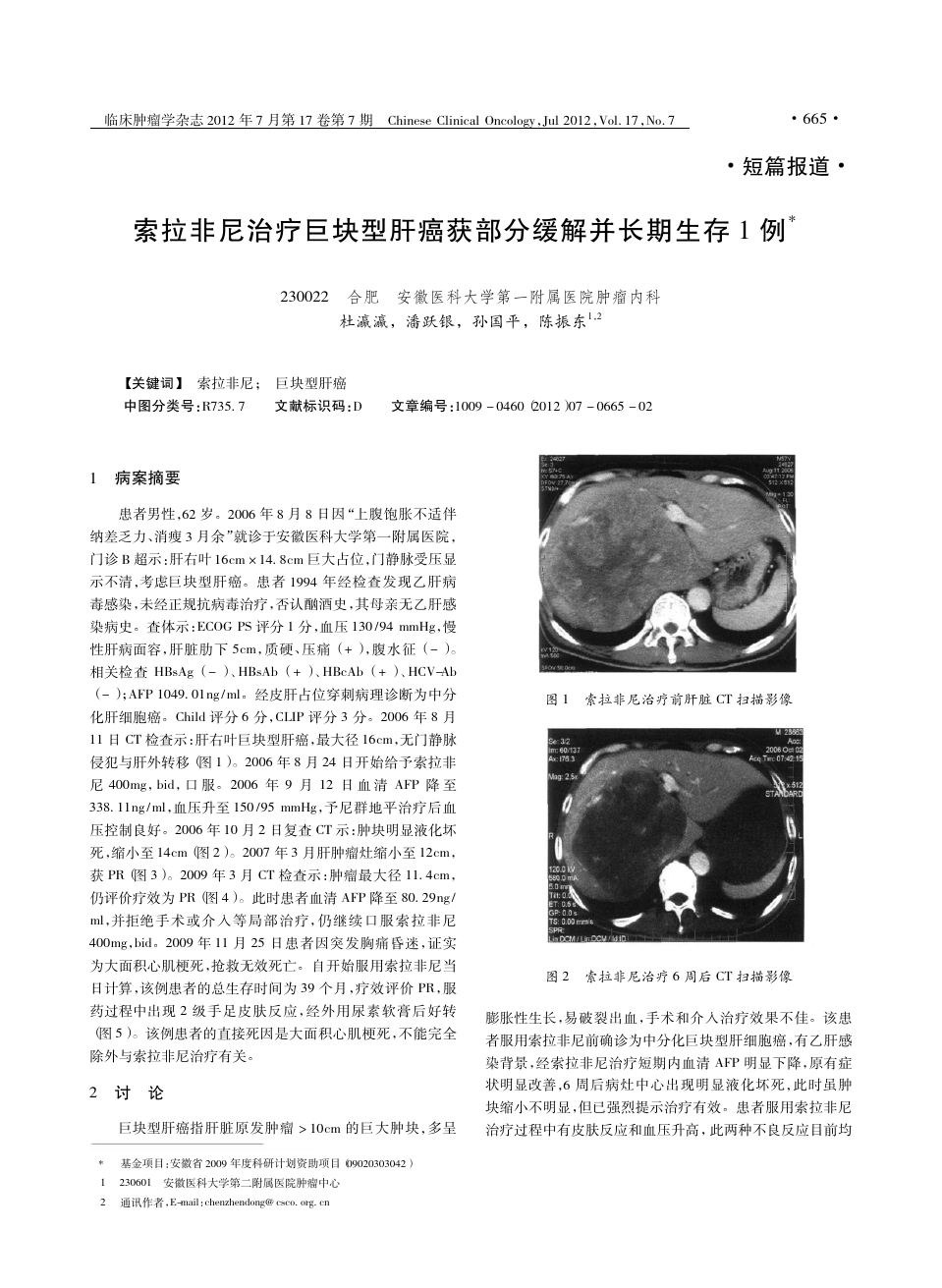 索拉非尼药靶向药_索拉非尼片_泰瑞莎靶向药赠药申请