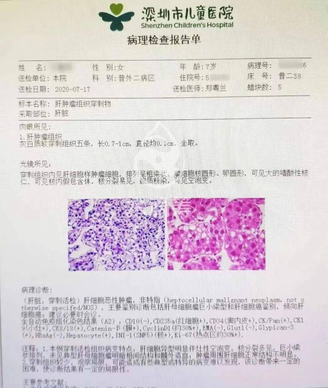 索拉非尼 肝癌_肝癌的索拉非尼_肝癌晚期水肿吃索拉非尼