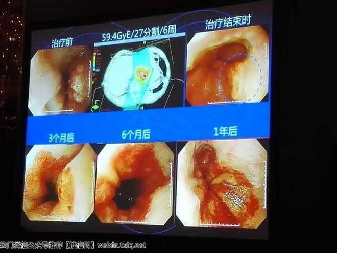 贝伐珠单抗治疗卵巢上皮性癌单抗的应用