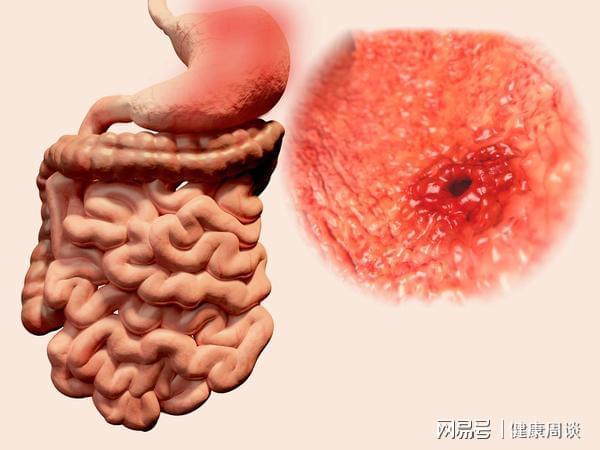 贝伐单抗能引起肠出血吗_贝伐单抗耐药性_贝伐珠单抗
