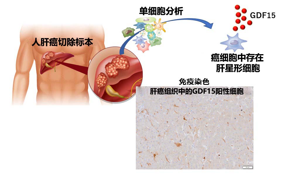 本文对近年来靶向药物治疗肝癌的进展进行总结(图)