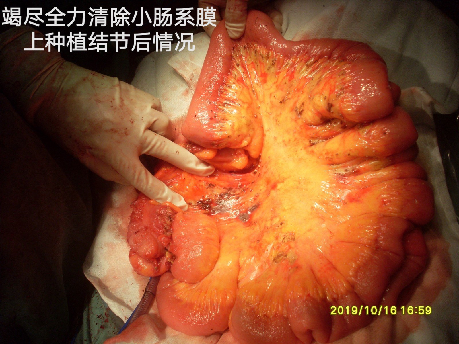 贝伐单抗治疗哪种癌症_贝伐单抗治疗耐药性卵巢癌_贝伐单抗的耐药时间