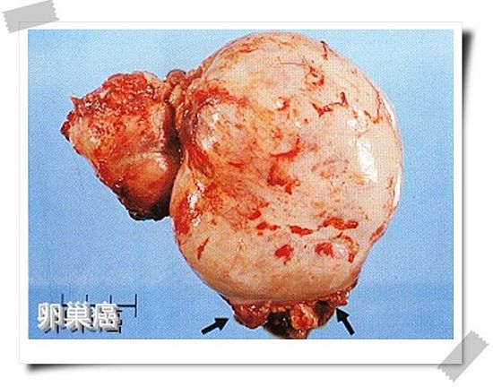 西妥昔单抗贝伐单抗_贝伐单抗治疗耐药性卵巢癌_贝伐单抗是靶向药吗
