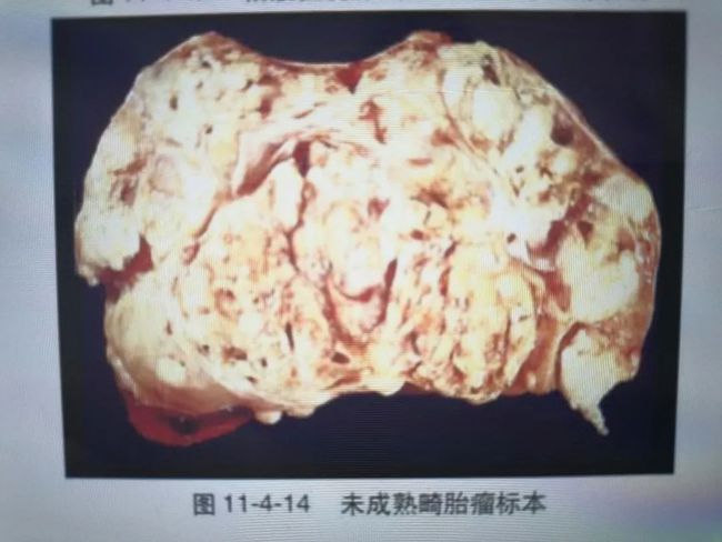 索拉非尼及其中间体_索拉非尼/治疗应用_索拉非尼间质瘤
